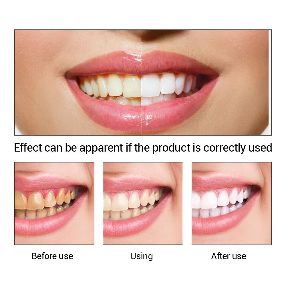 FTEENPLY Teeth Whitening Essen - Teeth Whitening Near Me review and price