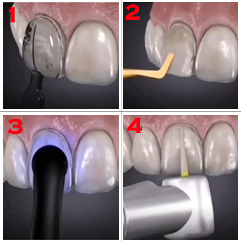 32Pcs Teeth Whitening Mould De - Teeth Whitening Moulds review and price