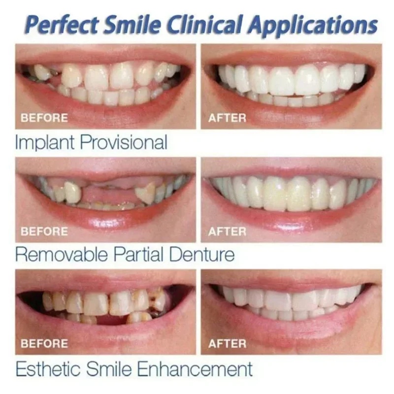 Snap-on Veneer Teeth Kit Adjus - Teeth Whitening Kit review and price