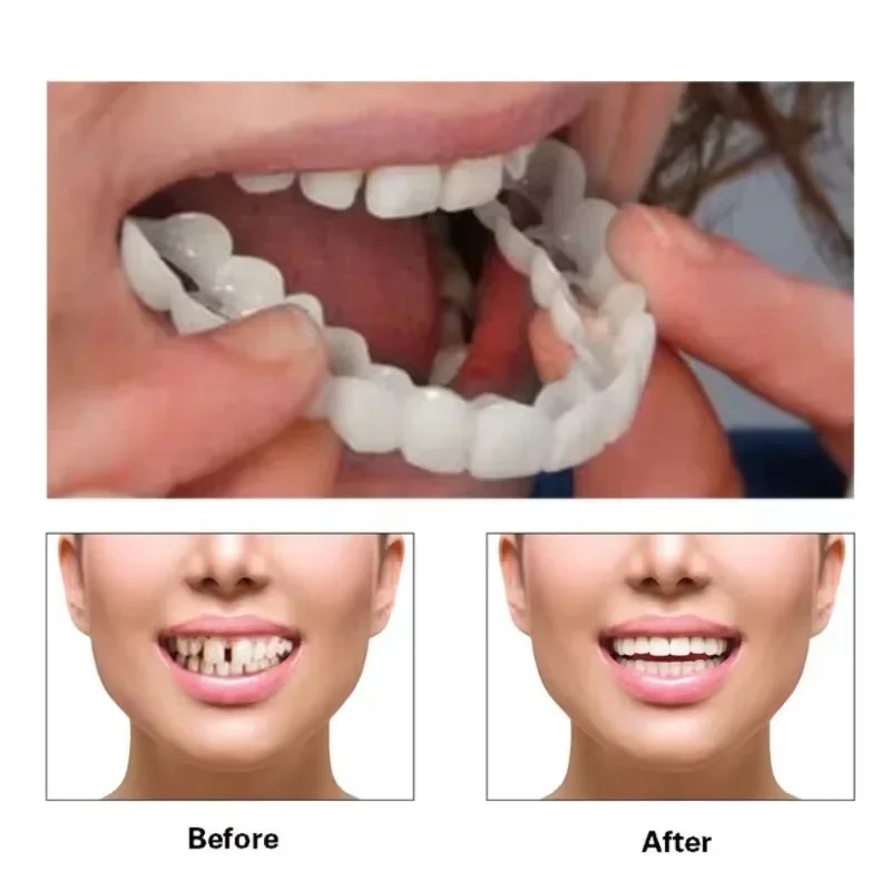 Snap-on Veneer Teeth Kit Adjus - Teeth Whitening Kit review and price